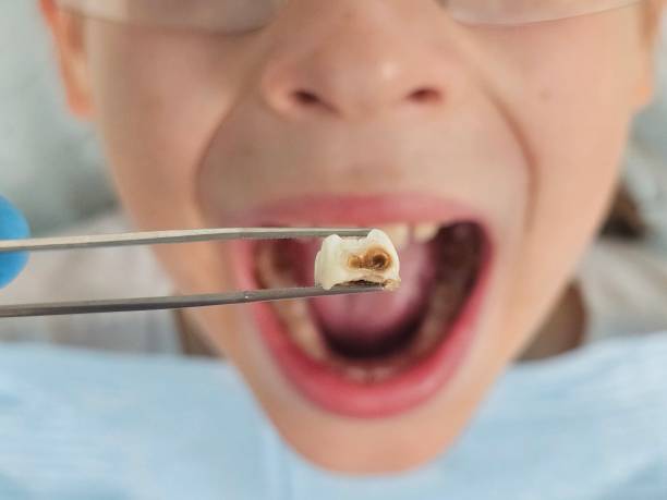 Best Broken or Chipped Tooth Repair in Estes Park, CO